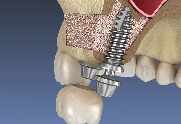 サイナスリフト