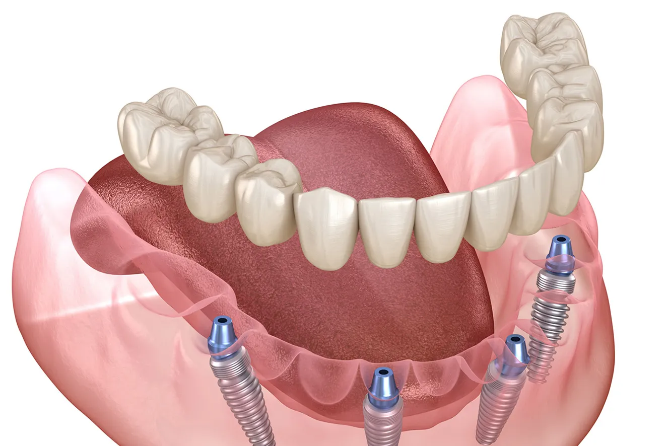 All-on-4、All-on-6、インプラントオーバーデンチャーの実施